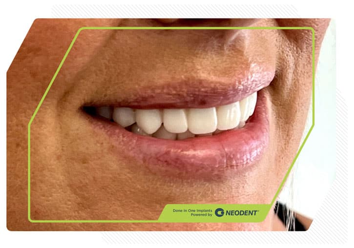 Zirconia Smiles 2