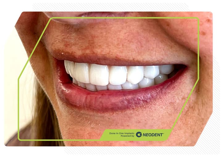 Zirconia Smiles 3