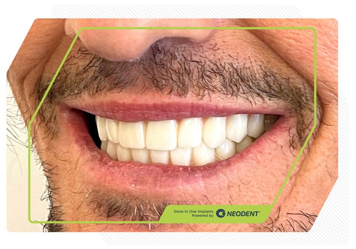 Zirconia Smiles 4