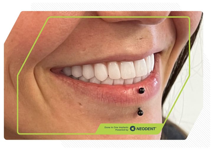 Zirconia Smiles 6