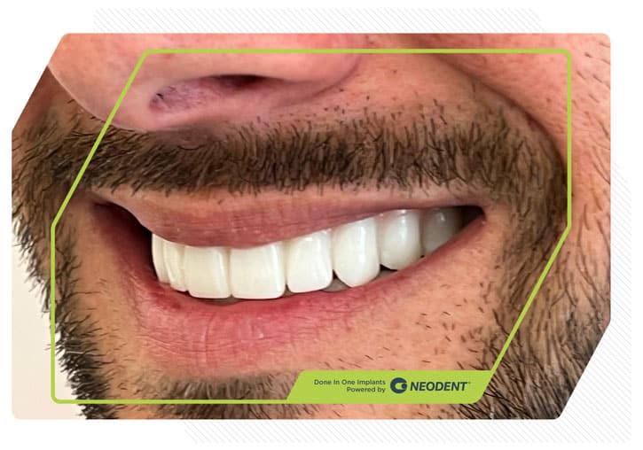 Zirconia Smiles 7