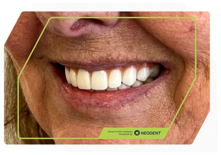 Zirconia Smiles 8