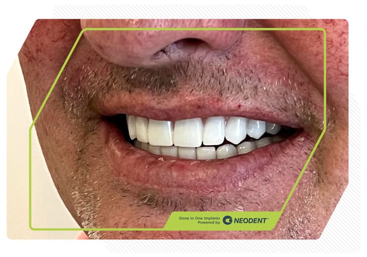 Zirconia Smiles 9