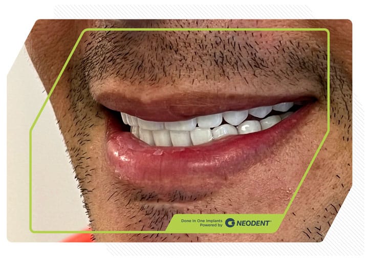 Zirconia Smiles 10