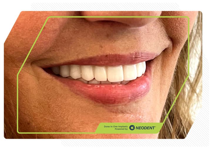 Zirconia Smiles 11